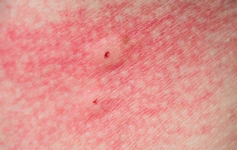 spider bites on skin