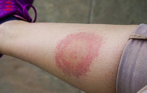 tick bite lyme disease